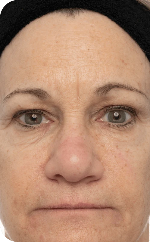 A close-up portrait of a woman with a neutral expression. She has a light brown complexion, visible facial wrinkles, and dark hair pulled back with a black headband. Her eyes are a light gray color, and her skin shows some blemishes and texture. The lighting is even, highlighting her facial features against a light background. The image captures her face straight on, centered in the frame.