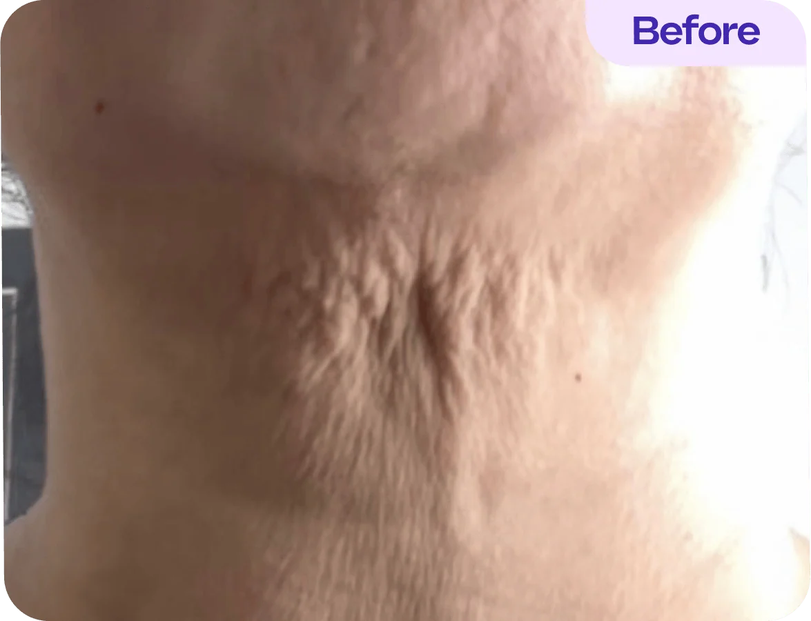 Close-up view of the nape of a person’s neck, showing skin texture and subtle wrinkles. The skin appears slightly loose, with lines and indentations visible. A label in the upper right corner reads "Before," indicating this is a comparative image in a skincare or rejuvenation context. The background is blurred, focusing attention on the neck area.