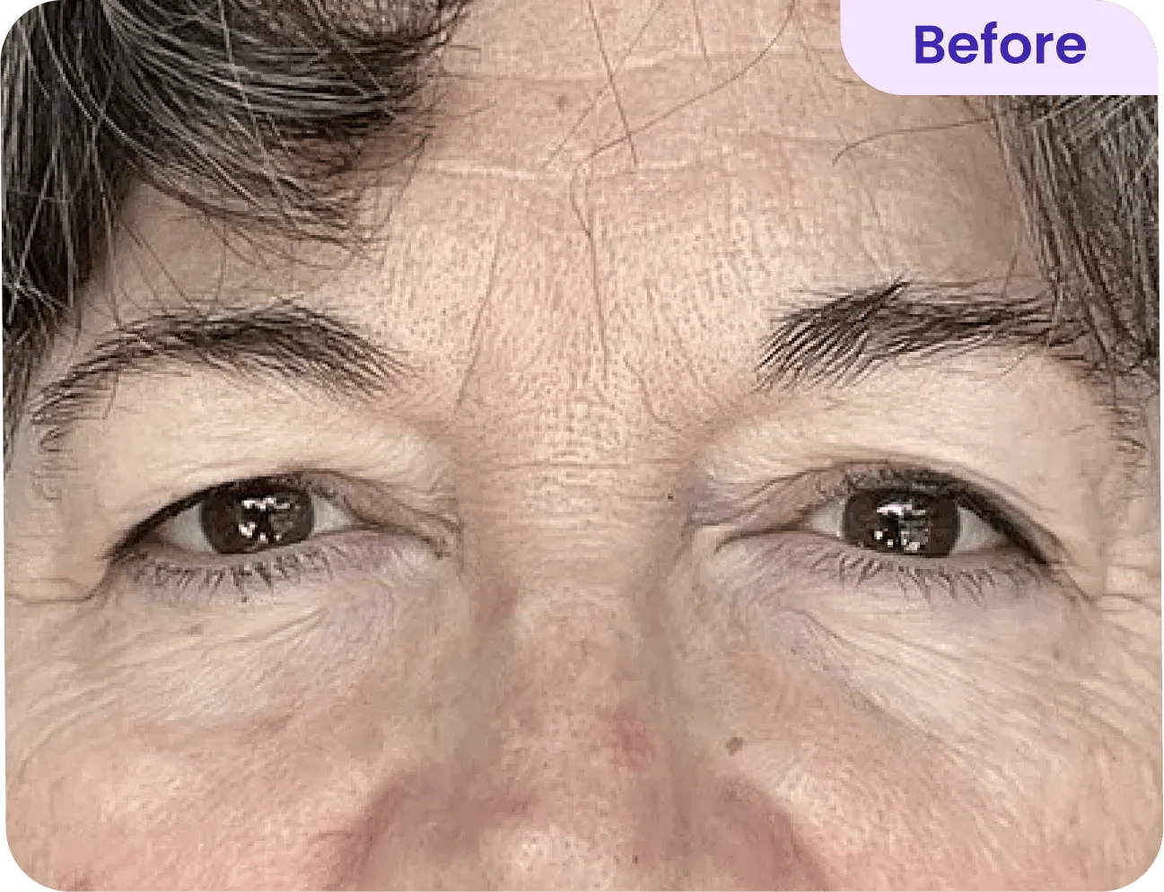 Close-up of a person's face focusing on their eyes and forehead. The skin shows natural aging signs, including fine lines and wrinkles. The person has dark brown eyes and slightly tousled gray hair. A label in the upper right corner reads "Before," indicating this image is part of a comparative analysis or transformation process. The overall expression appears neutral, and the lighting highlights the textures of the skin around the eyes.