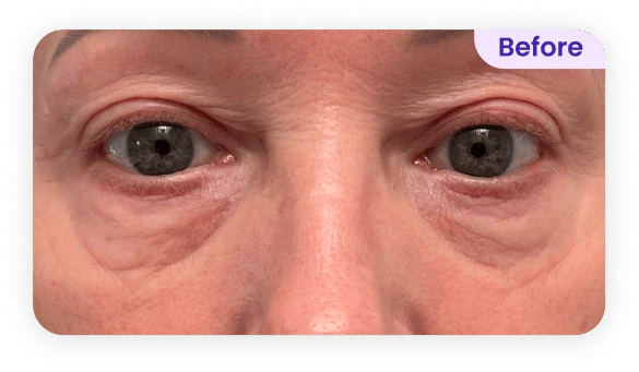 Close-up view of a person's eyes, showing visible signs of fatigue and puffiness. The skin around the eyes appears slightly wrinkled and there are dark circles under the eyes. The irises are a light gray color. The image is labeled "Before" in the top right corner, indicating it is a preliminary stage before a potential treatment or improvement. The background is a neutral shade, emphasizing the focus on the eyes.