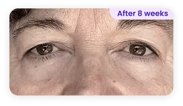Close-up view of a person's face focusing on their eyes. The individual appears to have subtle changes around the eyes, which suggest improvement or rejuvenation. The skin looks slightly smoother with fewer fine lines compared to a previous state. The words "After 8 weeks" are displayed in a purple box at the top right corner, indicating a timeline for the observed changes. The overall expression is neutral and calm.