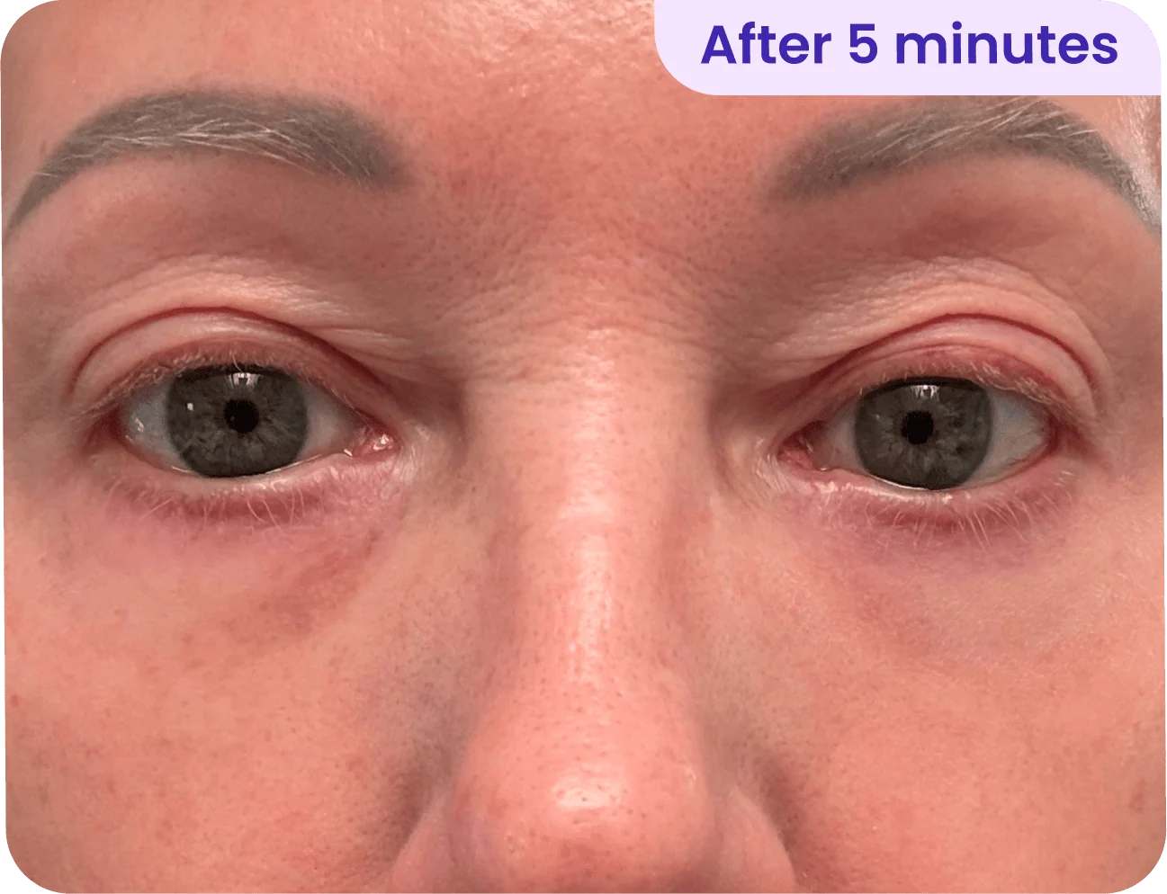 A close-up image of a person's face focusing on the eyes. The individual has light skin with subtle freckles and gray eyebrows. The eyes appear slightly puffy with a hint of redness, indicating a change from their previous state. A label in the upper right corner reads "After 5 minutes." The overall lighting is natural, and the background is blurred to emphasize the facial features.
