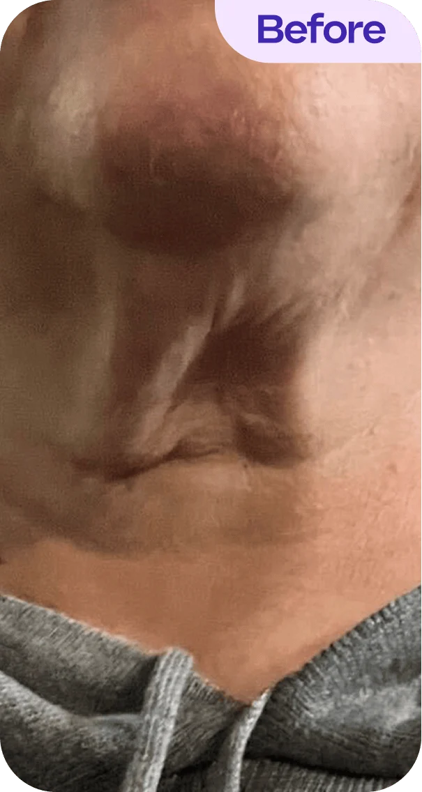 A close-up view of a person's neck and upper chest area, showing skin texture and folds. The skin appears to have some areas of shadow and light, highlighting the contours. The individual is wearing a gray hoodie, and the image is labeled "Before" in the top right corner. The focus is on the skin without any specific details about the person's identity or background.