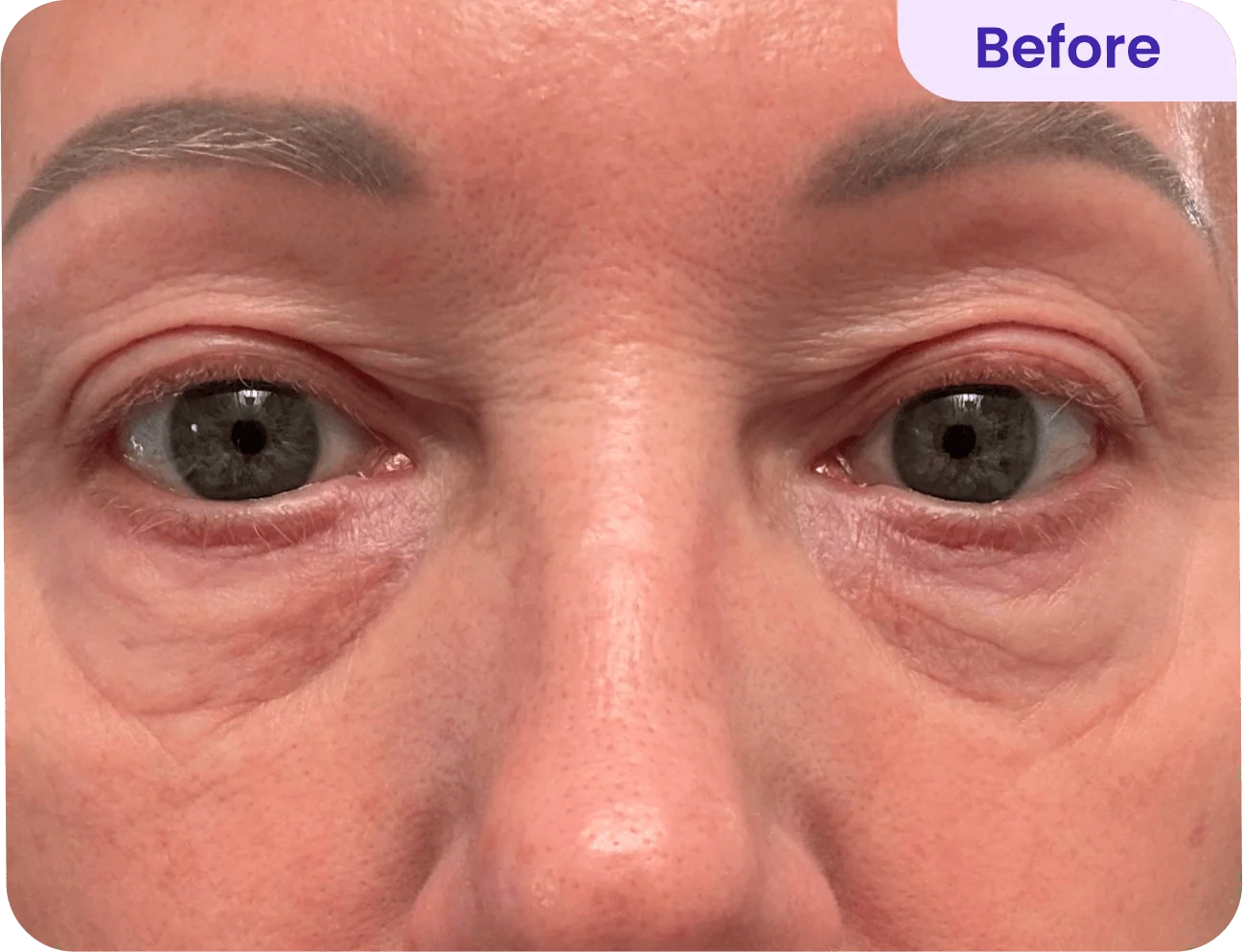 A close-up view of a person's face focusing on their eyes. The individual has light skin, gray eyes, and well-groomed eyebrows. There are visible signs of aging around the eyes, including fine lines and slight puffiness. The image is labeled "Before," indicating it may be part of a comparison highlighting a cosmetic treatment or skincare routine. The overall expression is neutral. The background is soft, not distracting from the facial details.