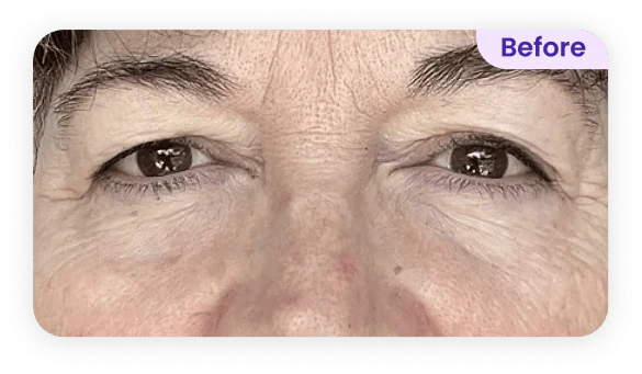 Close-up image of a person's eyes and forehead, showing fine lines and wrinkles around the eyes. The skin appears slightly sagging with visible dark circles beneath the eyes. The image is labeled "Before" in the top right corner. The overall expression is neutral, with the person looking directly at the camera. The background is simple and unobtrusive, focusing attention on the eyes and surrounding skin.