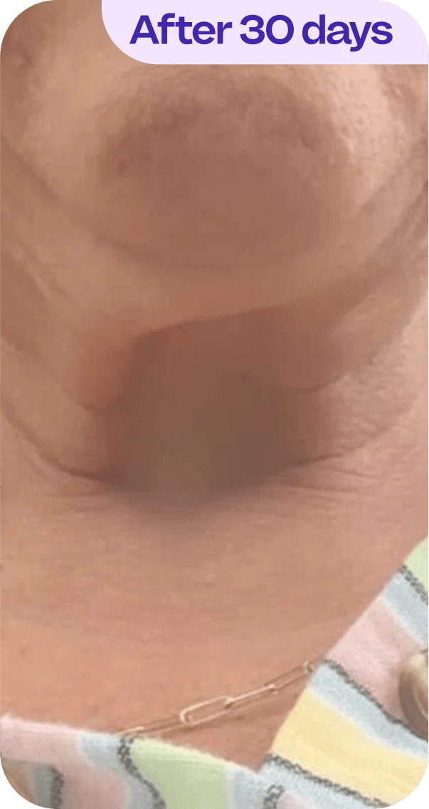 A close-up image of a person's neck and chin area featuring subtle skin texture. The background shows a portion of a striped garment. In the corner, there is the text "After 30 days" in purple. The skin appears to have improved in texture or firmness over a 30-day period, conveying a potential result of a skincare treatment or regimen.