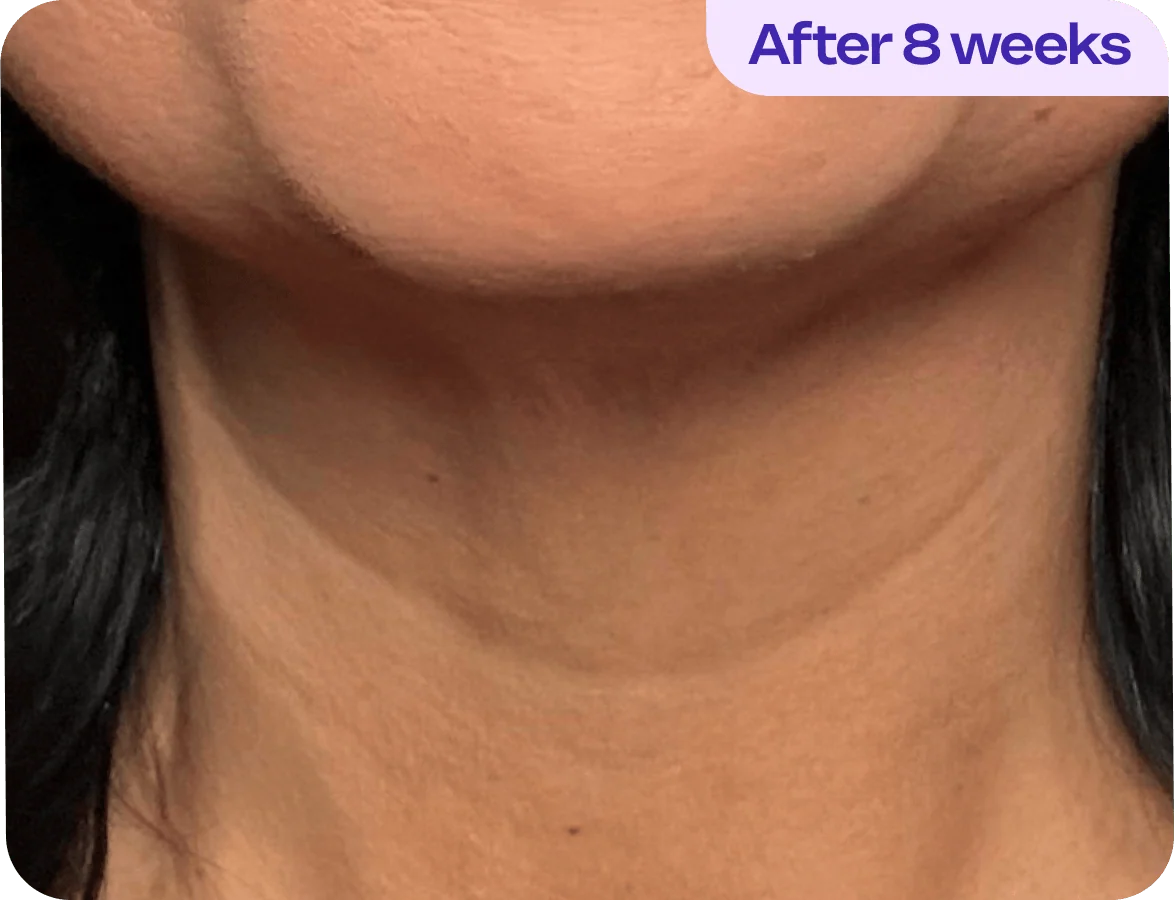 An image showing the lower part of a person's neck and chin area, highlighting skin texture. The skin appears smooth and even-toned, suggesting improvement over time. There are no visible blemishes or irregularities. In the top right corner, there is a text overlay stating "After 8 weeks," indicating a time frame for skin treatment or regimen results. The background is neutral, allowing the focus to remain on the skin's appearance.