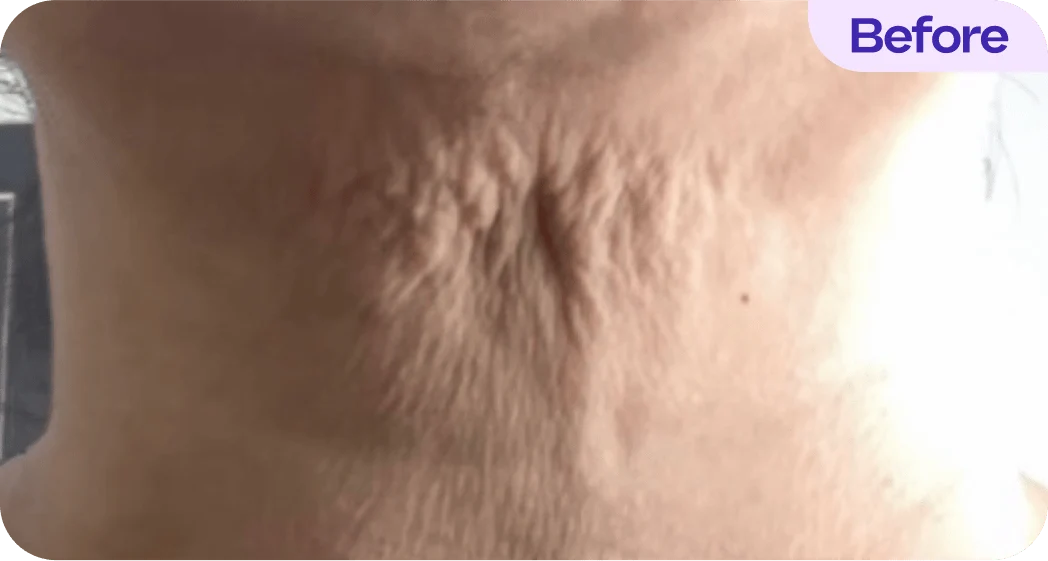 Close-up view of the neck showing skin texture. The skin appears loose and wrinkled, with noticeable creases and indentations in the middle area. The lighting enhances the visibility of these skin features. The image is labeled "Before" at the top right corner, suggesting it is part of a comparison or treatment process.