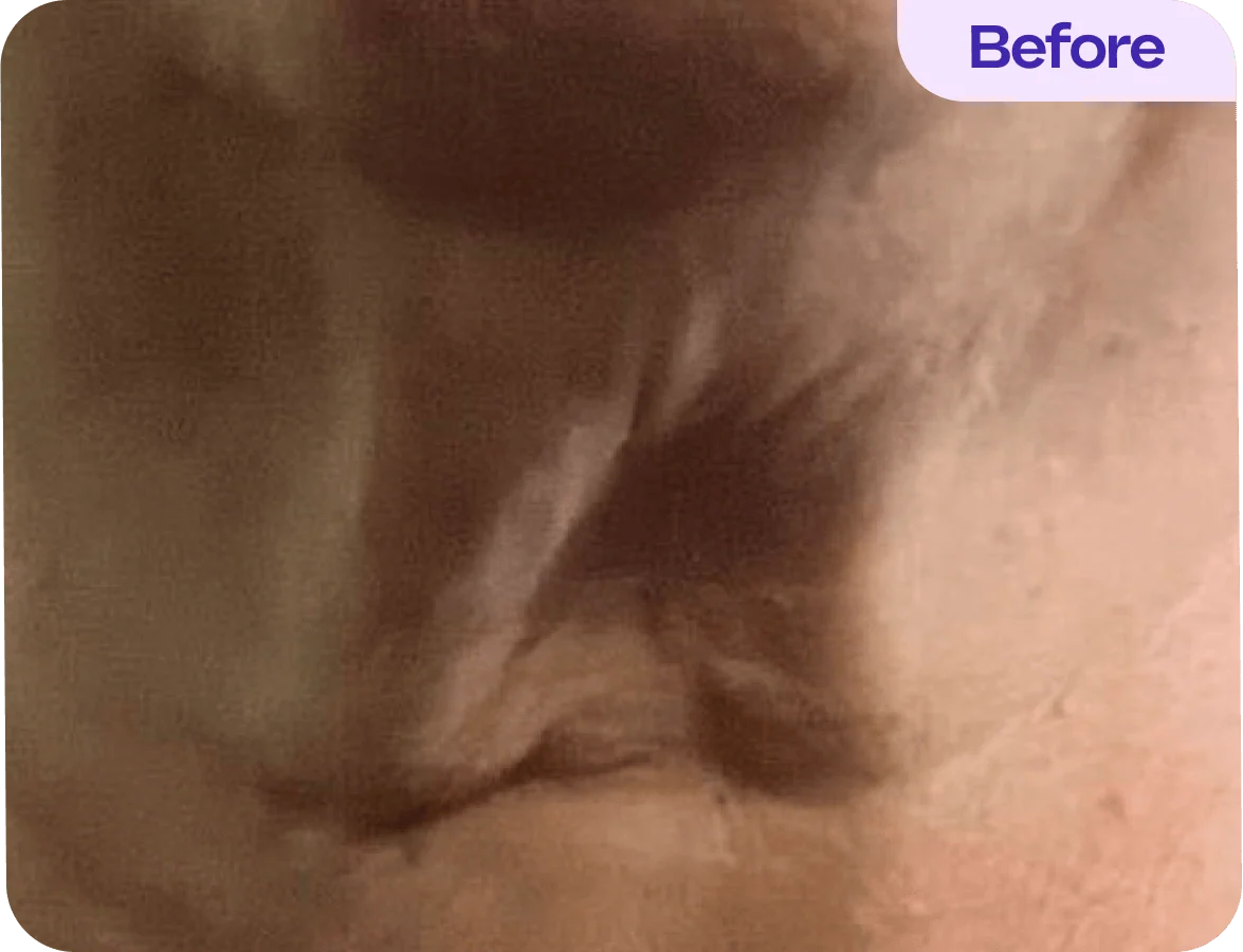 A close-up view showing skin texture and tones, with a focus on creases and folds. The image has a subtle, blurred appearance, emphasizing the skin’s natural color variations. In the top corner, the word "Before" is displayed in a purple box.