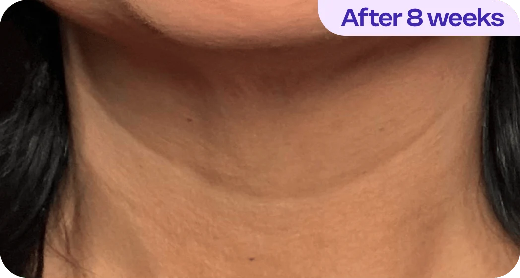 An image demonstrating the skin on a person's neck, labeled "After 8 weeks." The neck appears smooth and healthy, with even skin tone and minimal visible pores. The background is blurred, drawing attention to the skin's texture and condition. The overall appearance suggests an improvement in skin health.