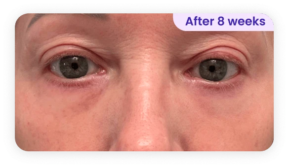 A close-up view of a person's eyes, showing a noticeable change after 8 weeks. The eyes appear clearer, with reduced puffiness and dark circles compared to a previous state. The skin around the eyes is smoother, indicating potential skincare or treatment improvements. The person's eyelids have a natural appearance, and the expression is neutral. The image is framed with a subtle border, highlighting the focus on the eye area and the timeframe mentioned.